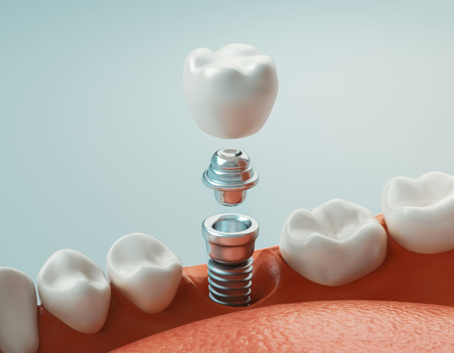 Dental Implants in SW Calgary