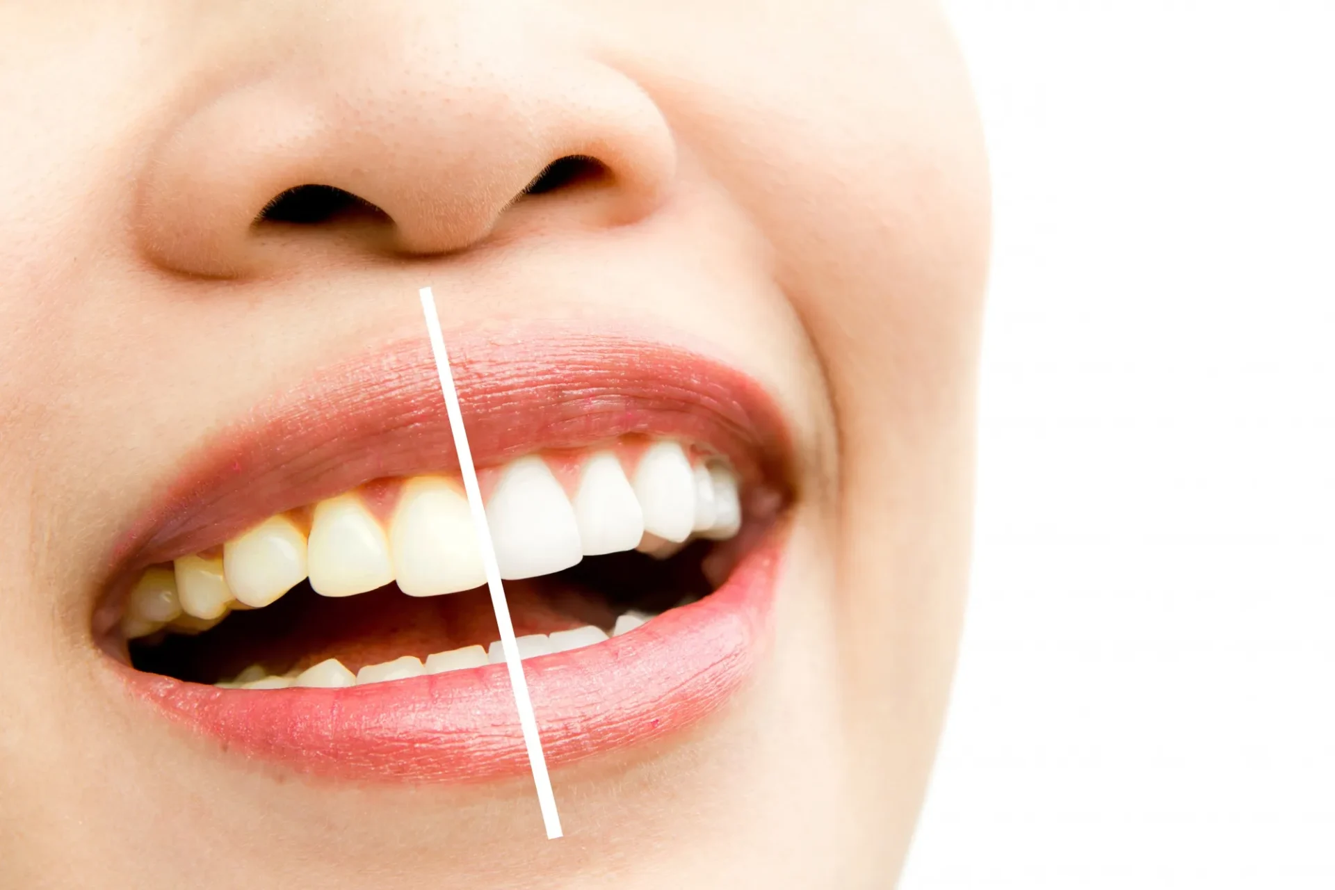 tooth discoloration causes professional whitening