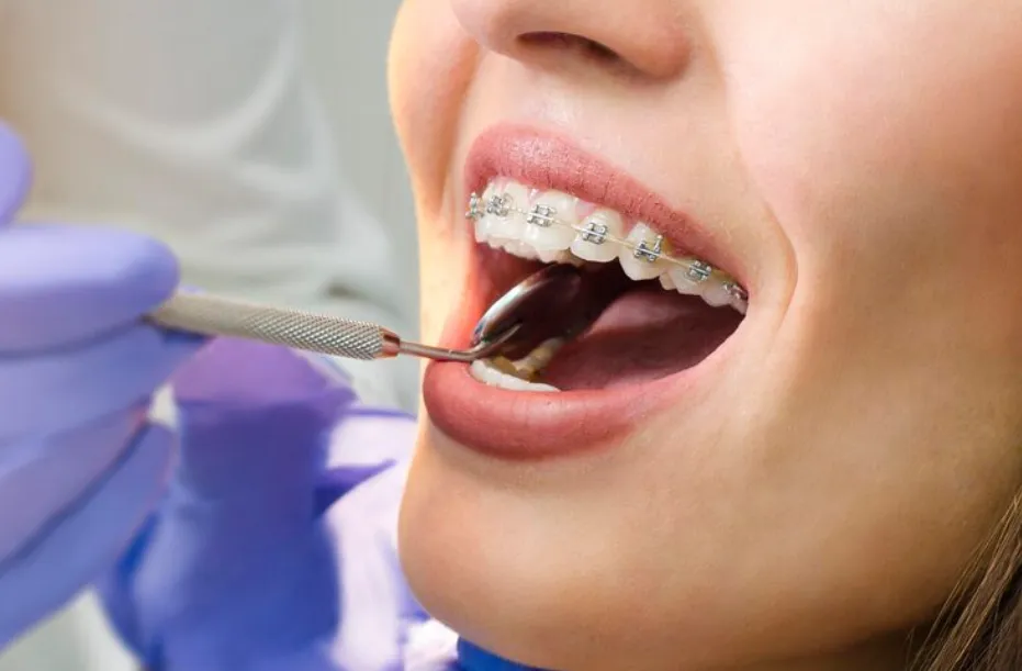 braces treatment timeline